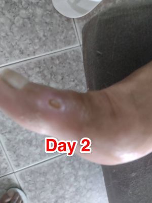 Case study chronic venous ulce 3.jpg