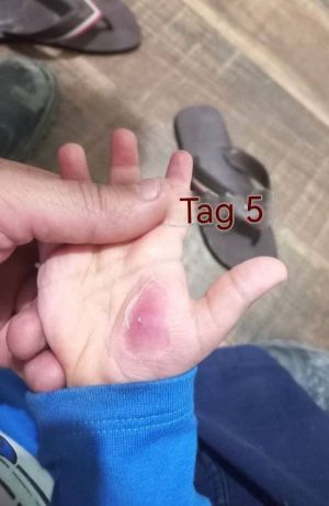 Case study toddler hand infect 6.jpg