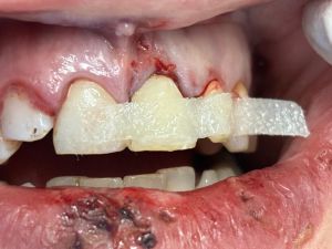 Dental Reimplant Trauma 9.jpg